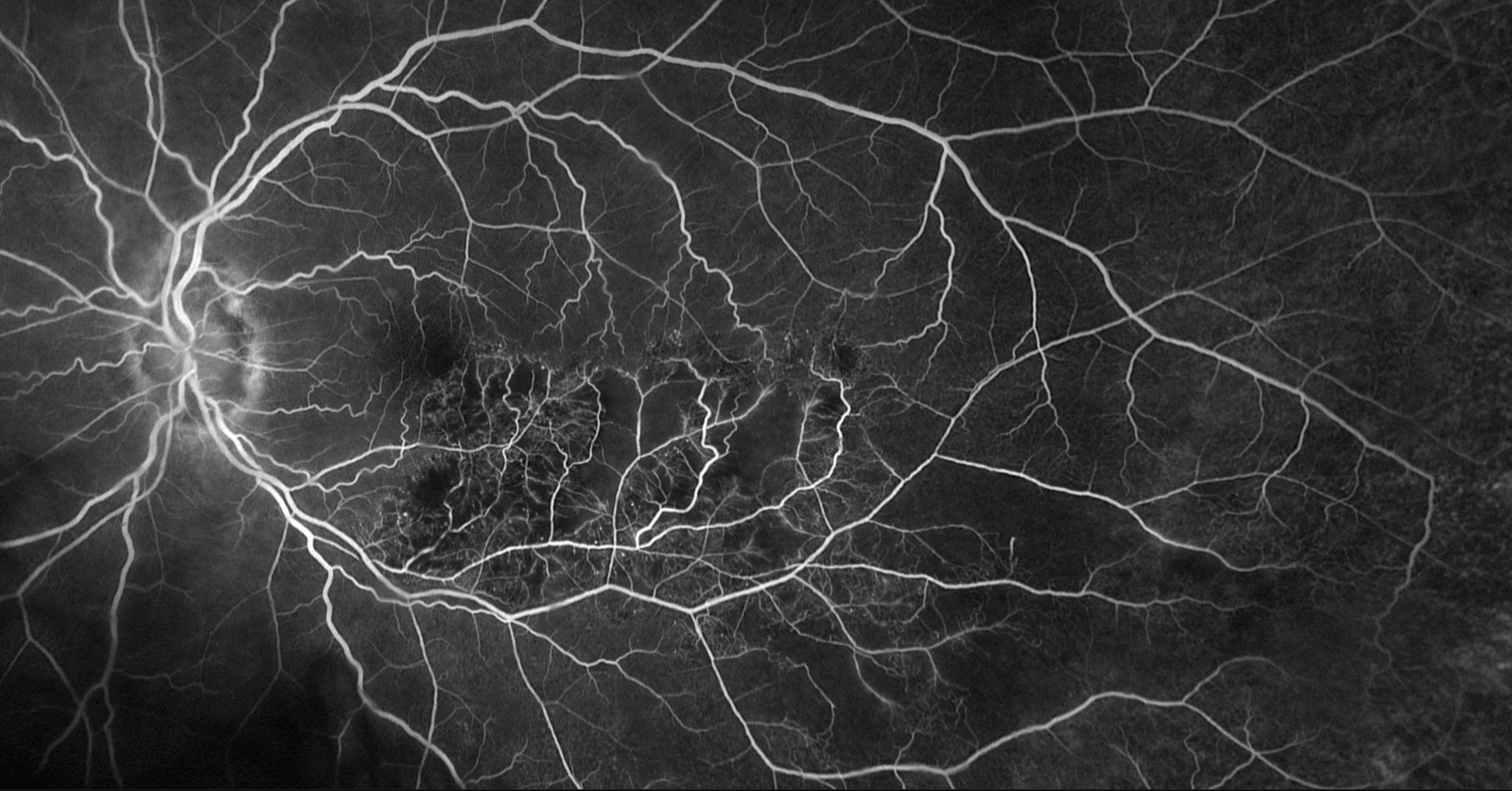 Fluorescein angiography image of the retina used to diagnose diabetic retinopathy and macular degeneration