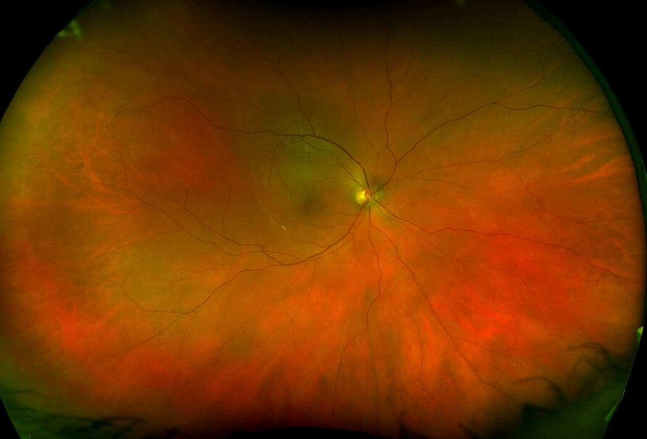 Ultra-widefield retinal photograph taken at North Indiana Retina in Mishawaka, Indiana